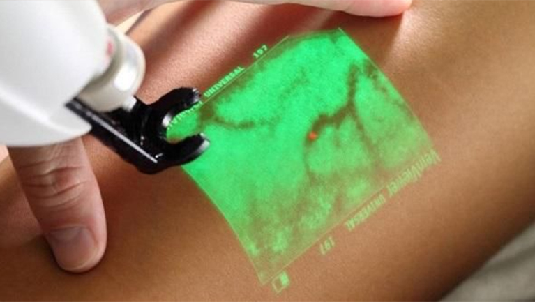 Tratamentos para varizes: espuma, laser e cirurgia. Qual o melhor?