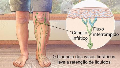 Linfedema