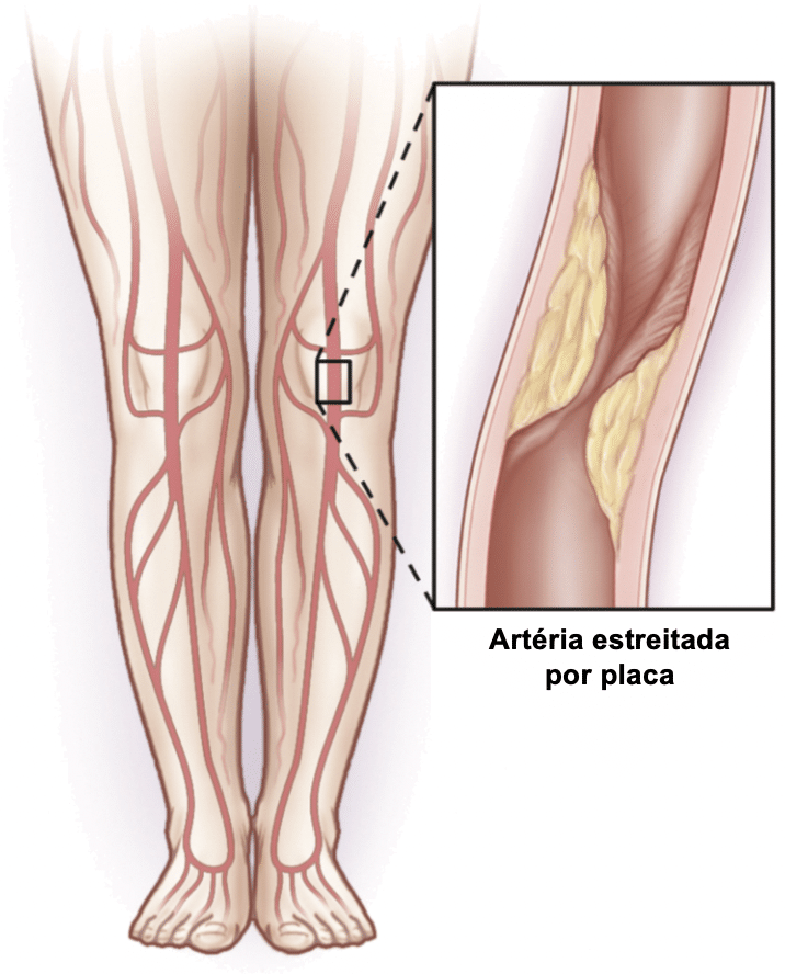 doença arterial periférica (DAP)