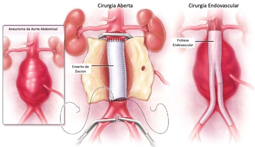 Cirurgia aberta