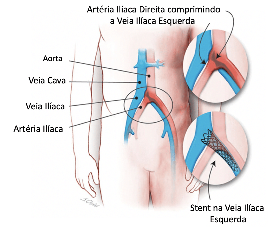 Tratamento endovascular