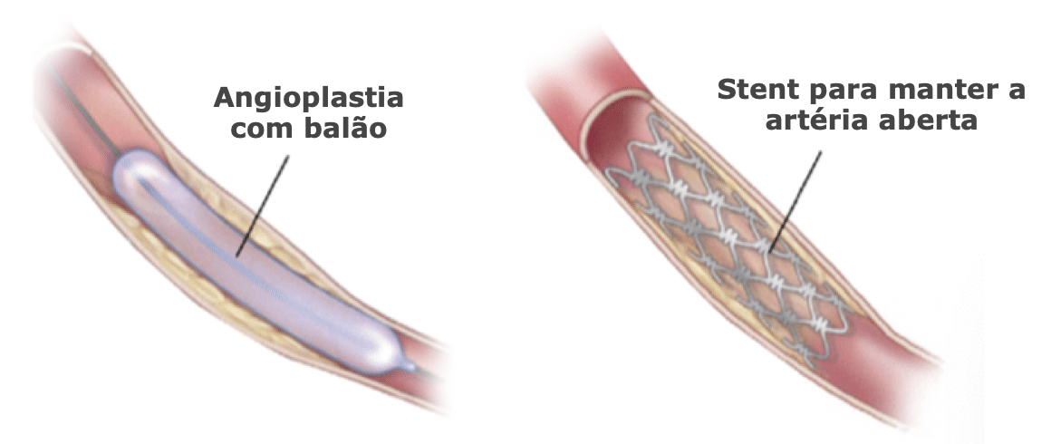 Tratamento endovascular