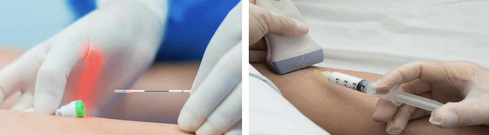 Laser endovenoso e Espuma densa