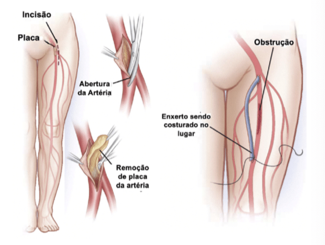 Revascularização cirúrgica