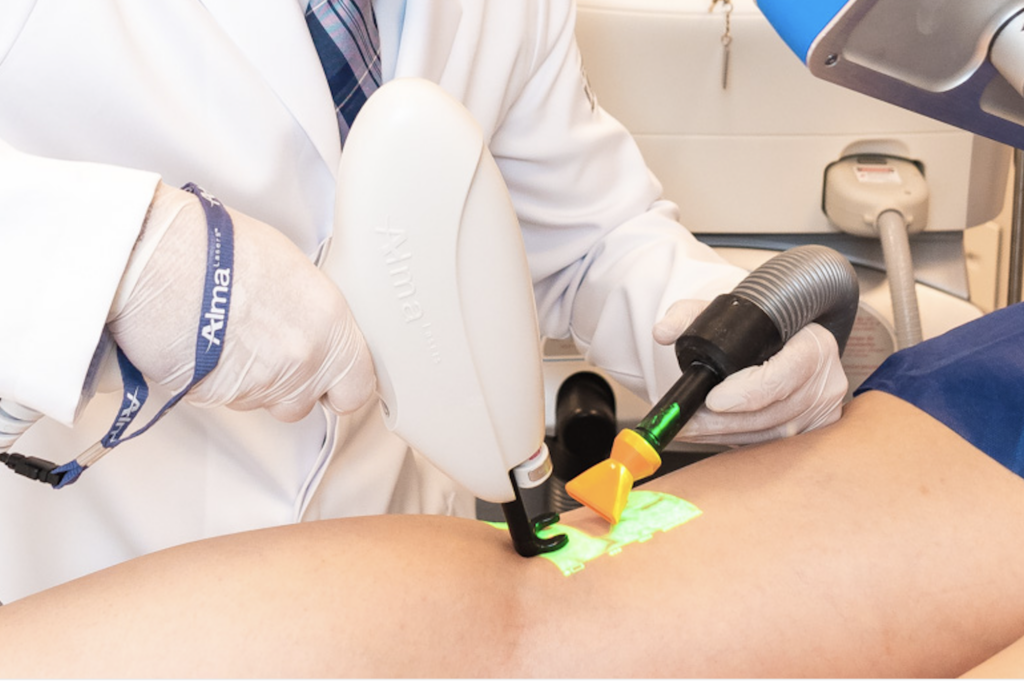 Laser endovenoso