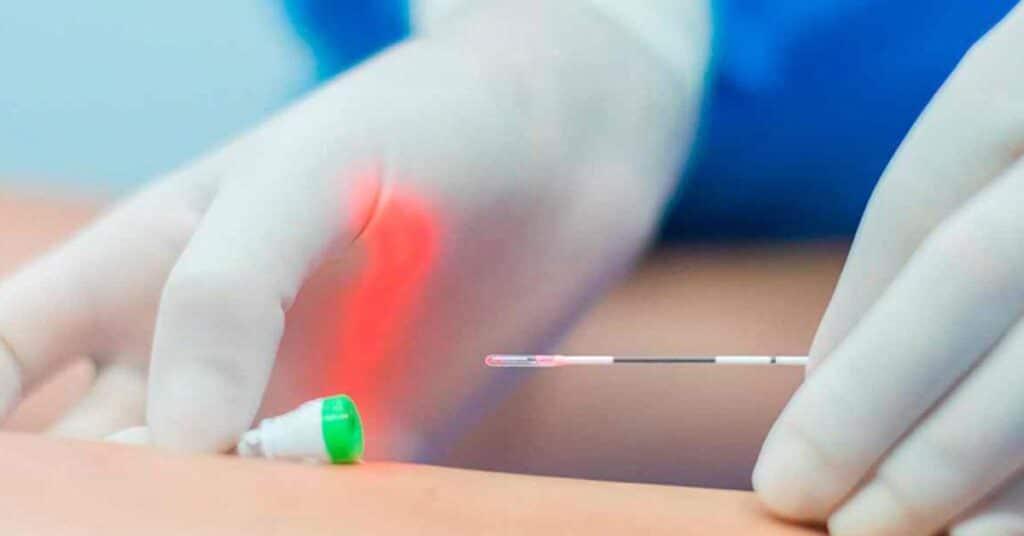 fibra de laser é introduzida dentro da veia