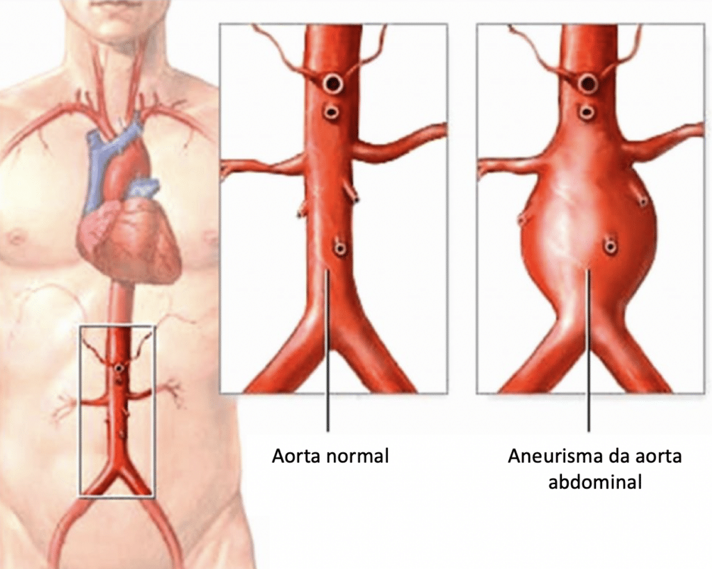 Aneurismas