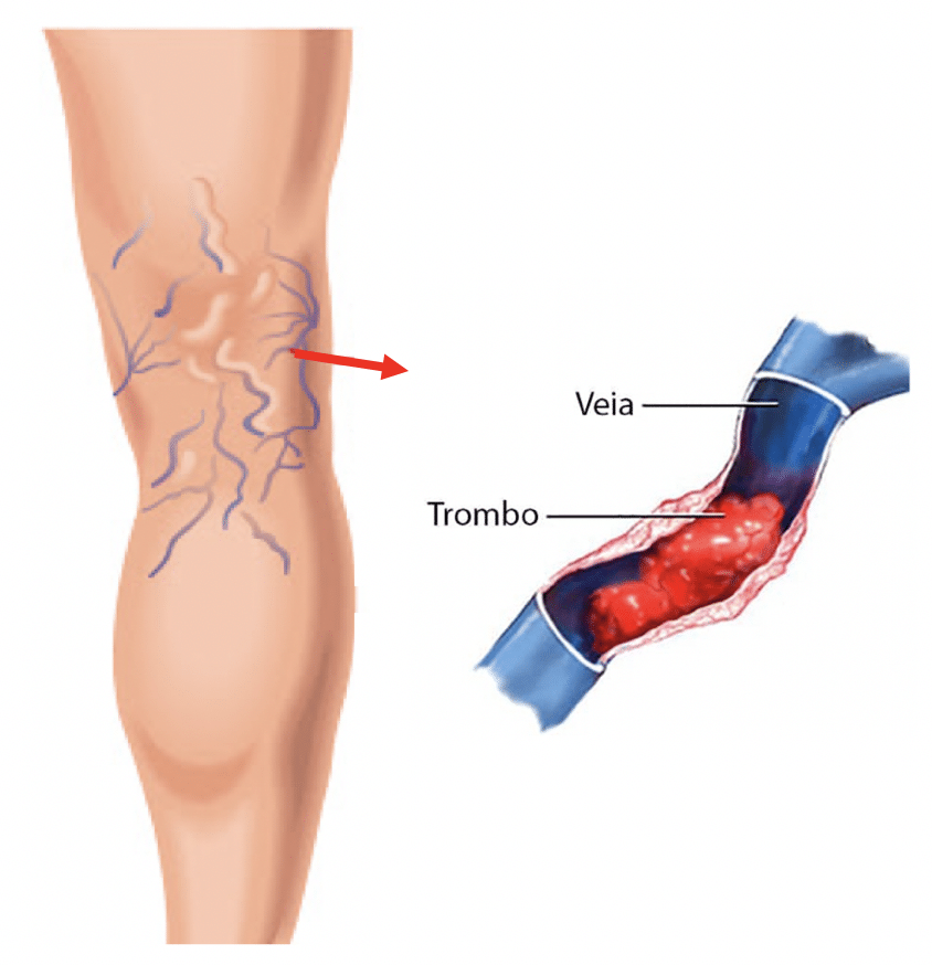 Flebite ou Tromboflebite