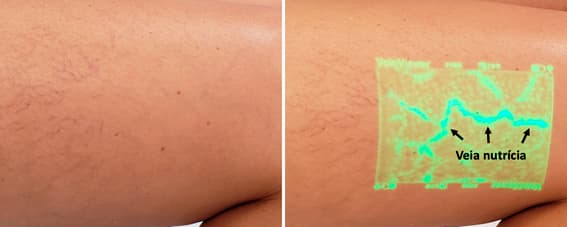 Tratamentos para varizes: espuma, laser e cirurgia. Qual o melhor?