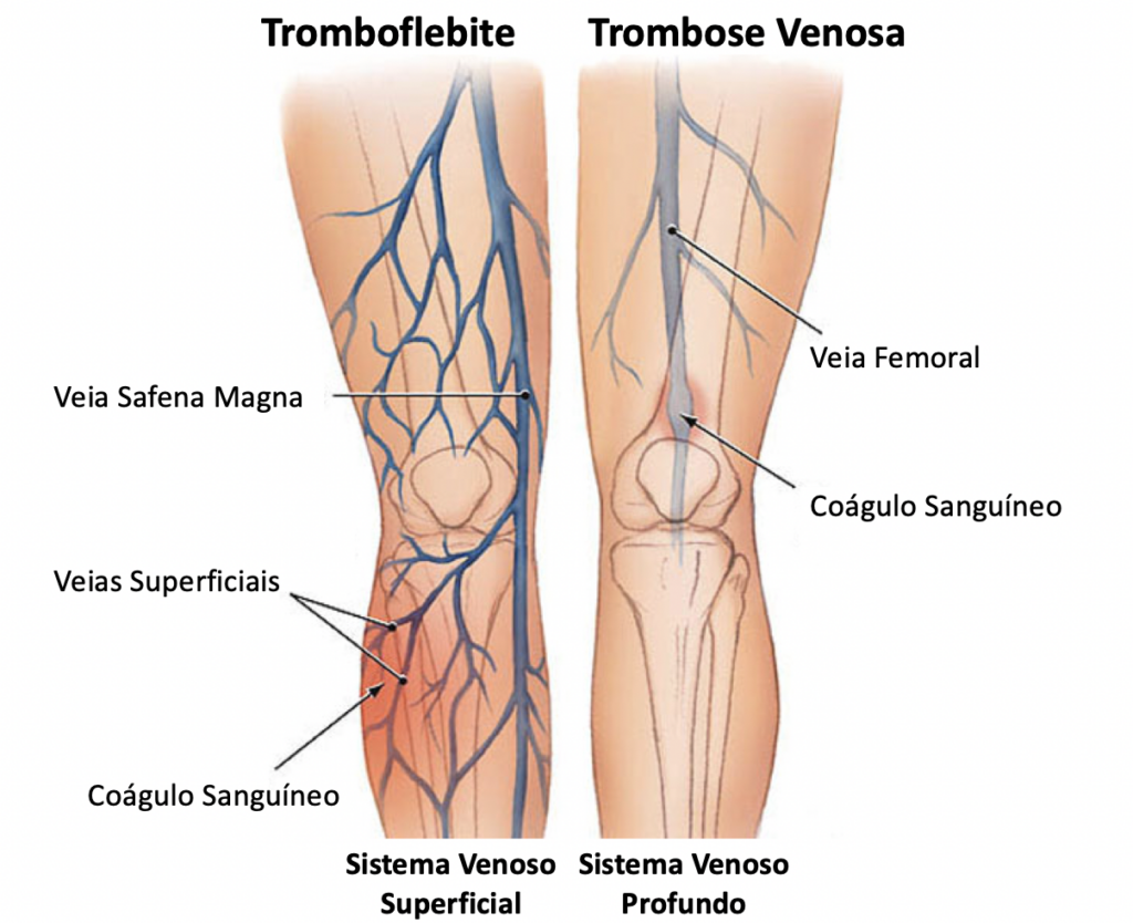 varicotromboflebite