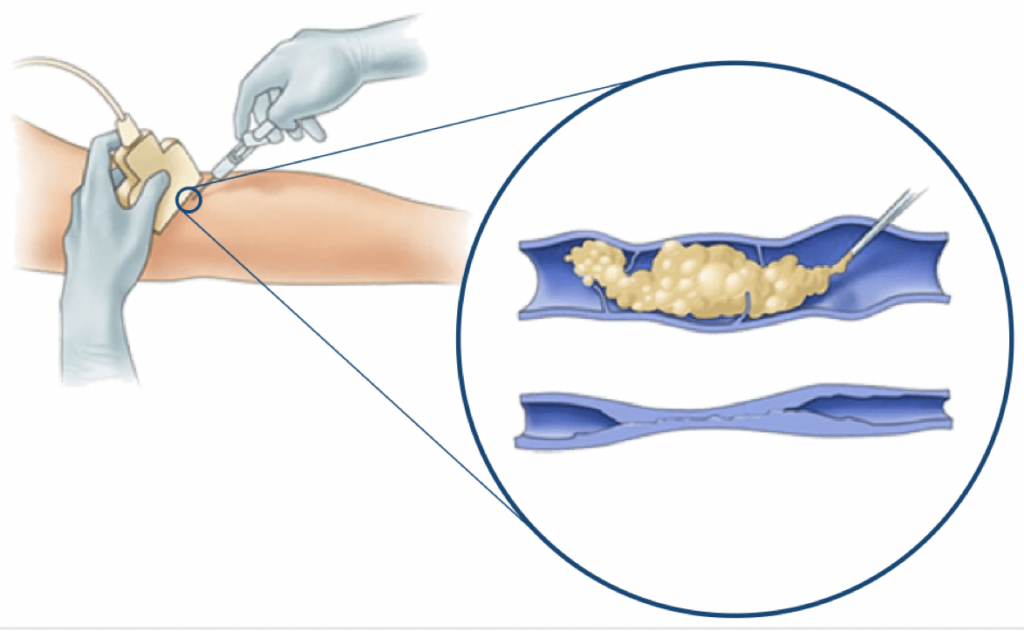 laser endovenoso