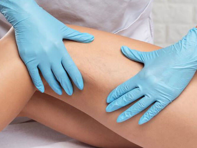 Angiologista examinando pernas de paciente com luvas cirúrgicas azuis