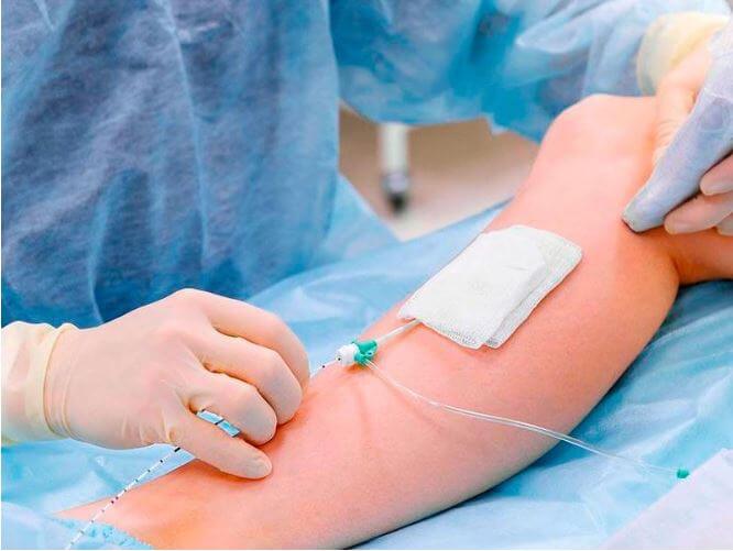 Cirurgião vascular realizando procedimento minimamente invasivo com laser em veia