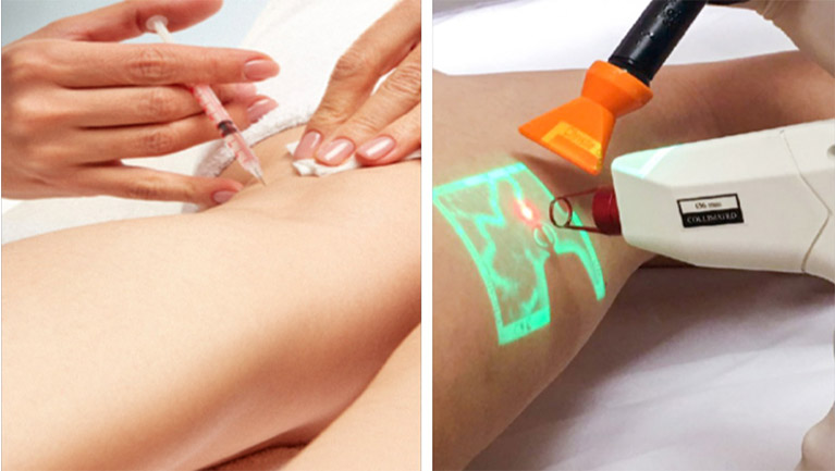 Por que associamos a escleroterapia ao laser transdérmico?